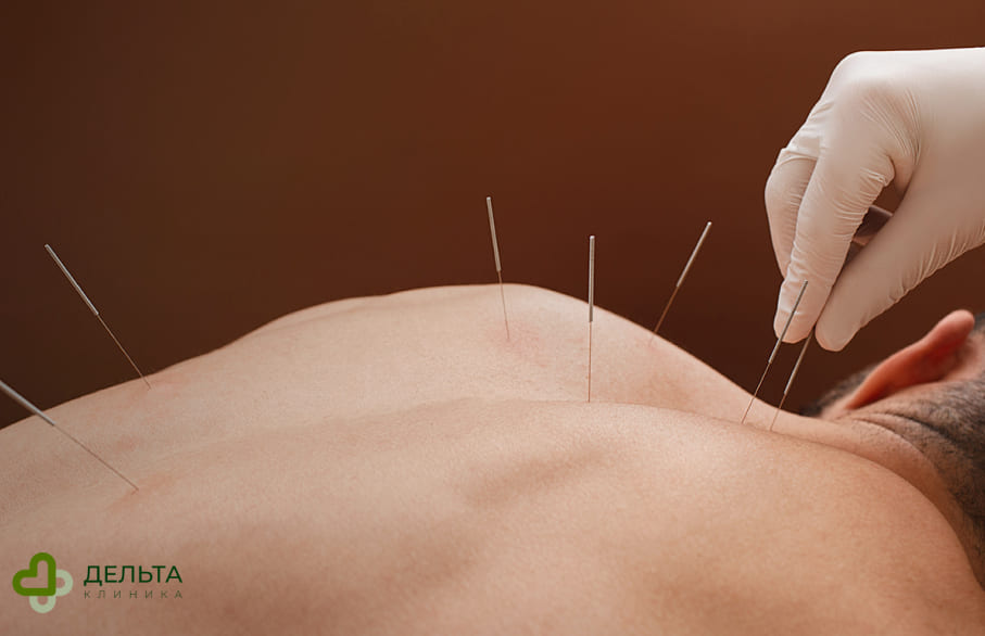 Мужчине делают иглоукалывание